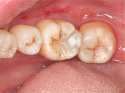 Full article: Restoring proximal caries lesions conservatively with .